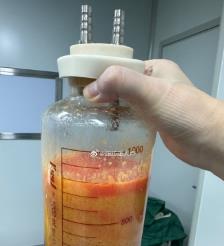 吉林水动力吸脂手术要做多久？